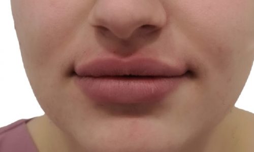 Ästhetischer Eingriff Lippen